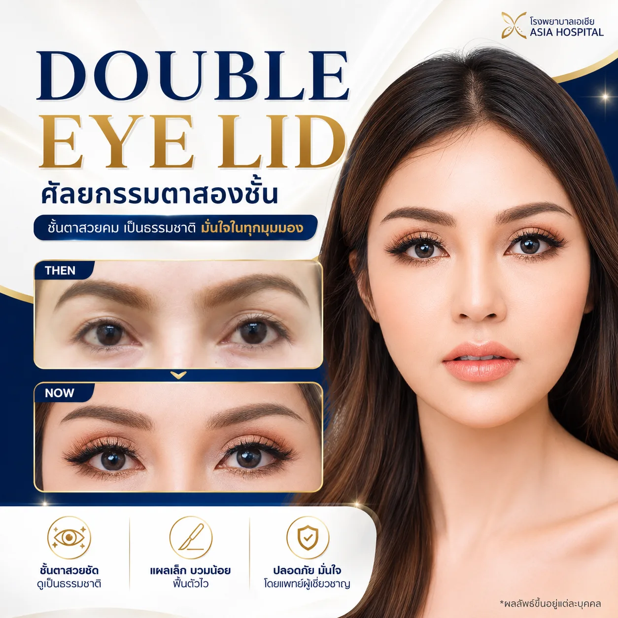 ก่อน-หลัง ศัลยกรรมตา
