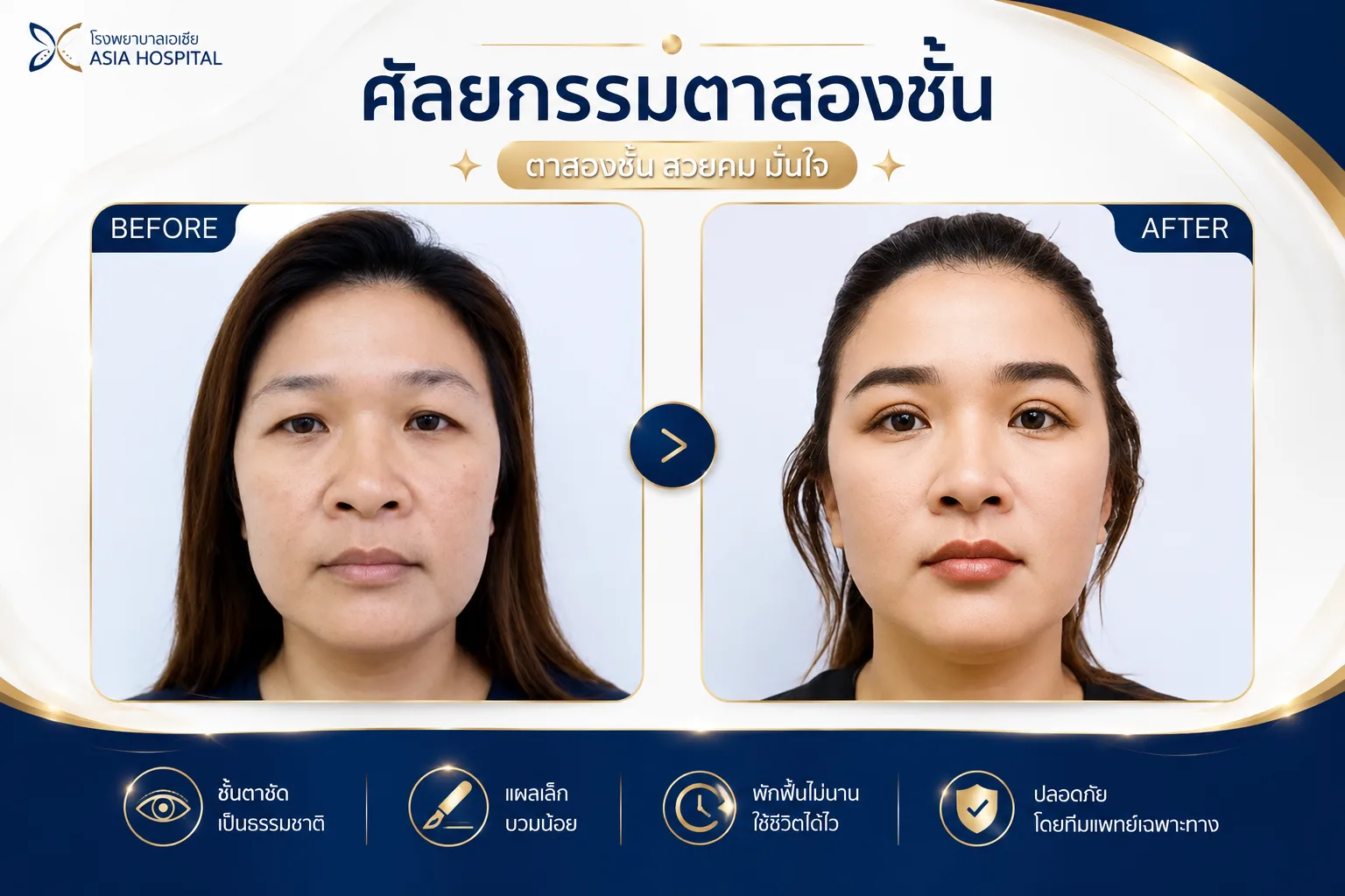ก่อน-หลัง ศัลยกรรมตา
