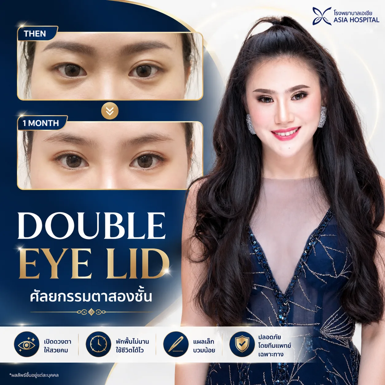 ก่อน-หลัง ศัลยกรรมตา
