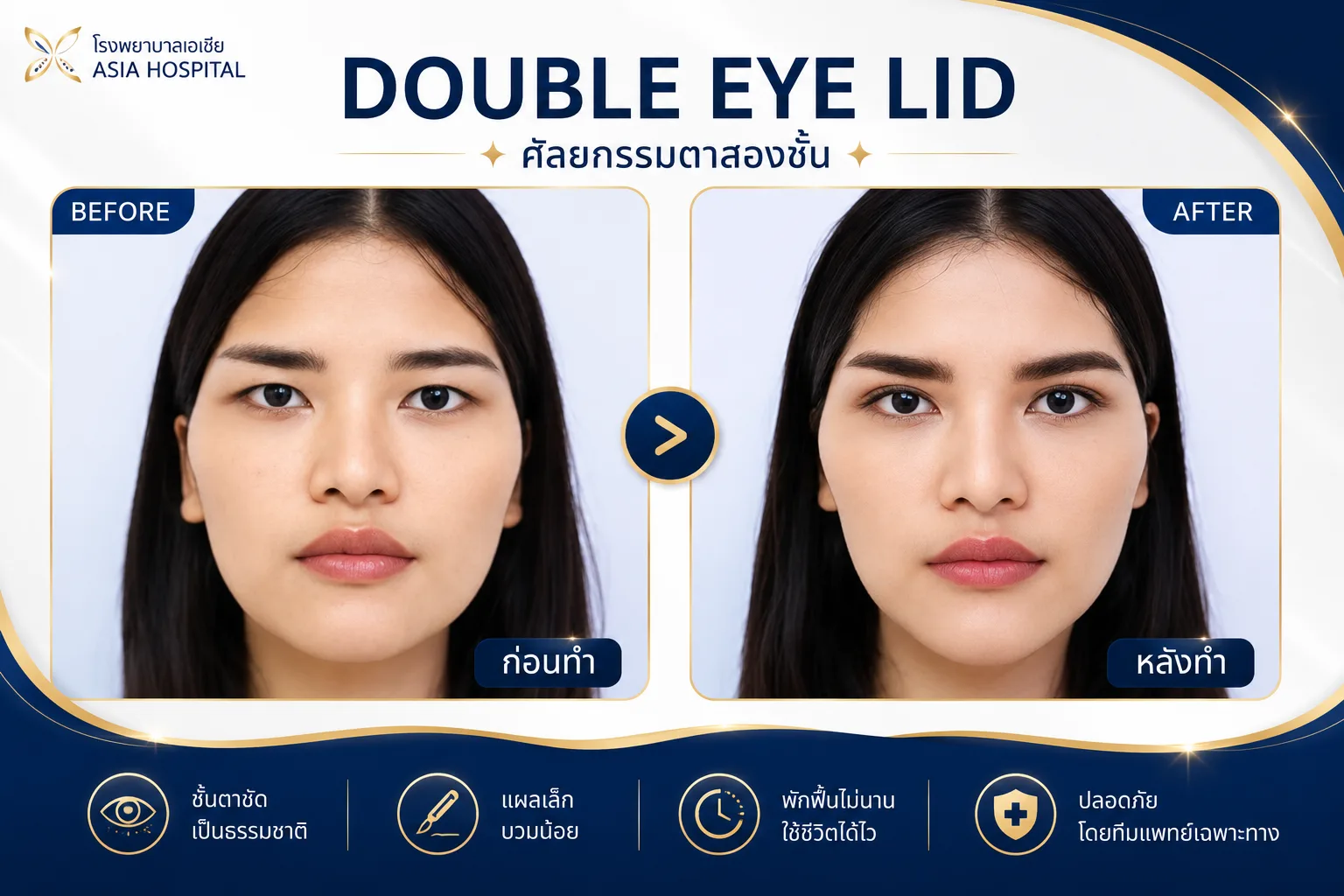 ก่อน-หลัง ศัลยกรรมตา