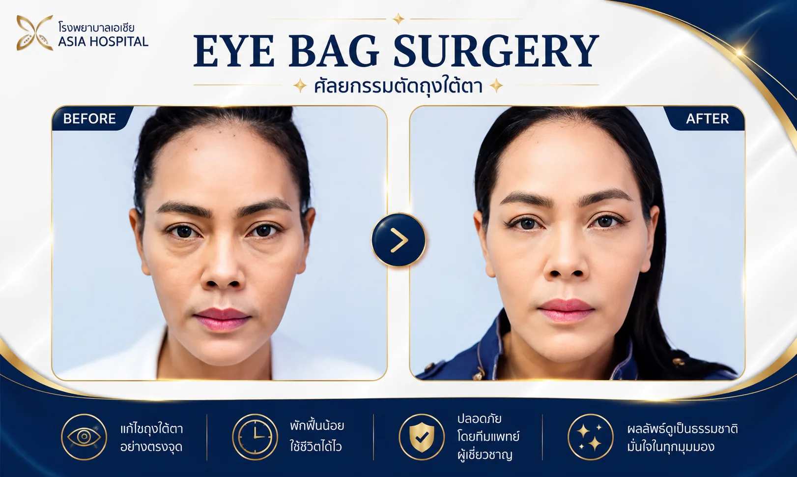 ก่อน-หลัง ศัลยกรรมตา