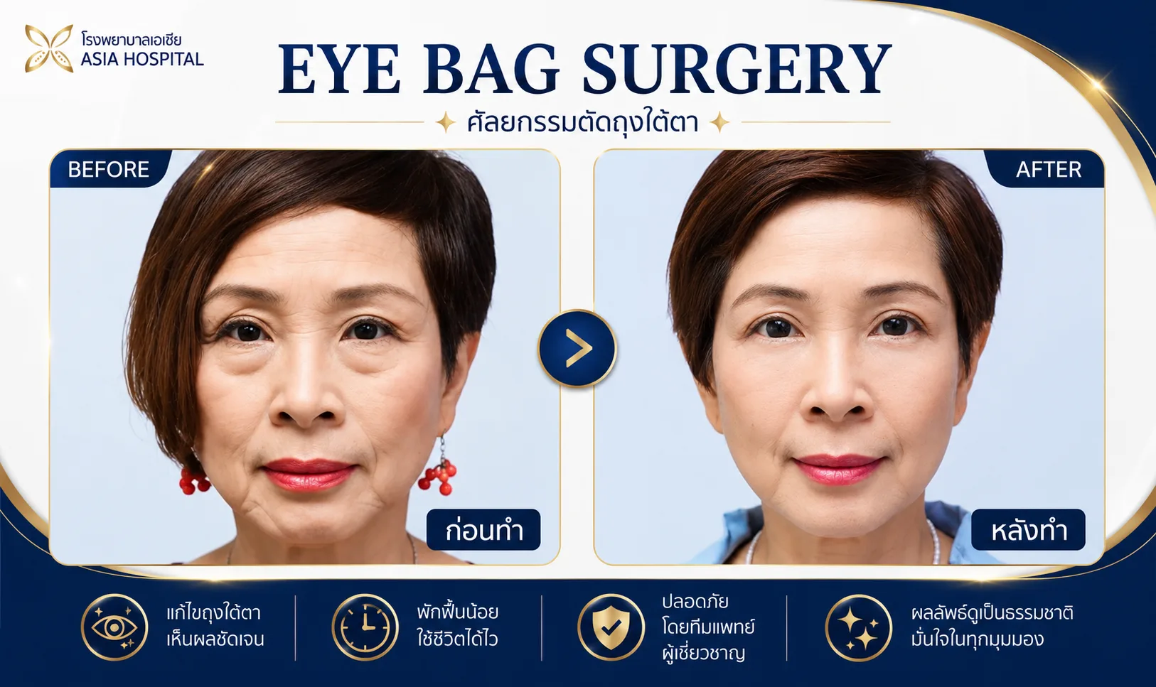 ก่อน-หลัง ศัลยกรรมตา