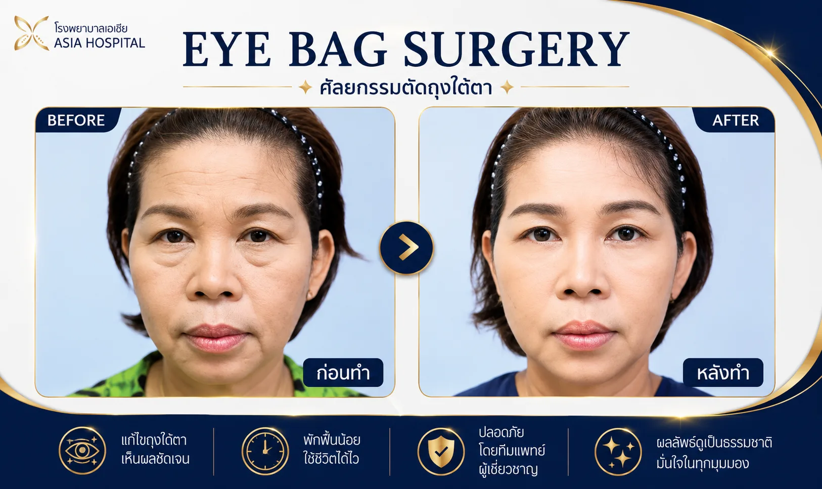 ก่อน-หลัง ศัลยกรรมตา