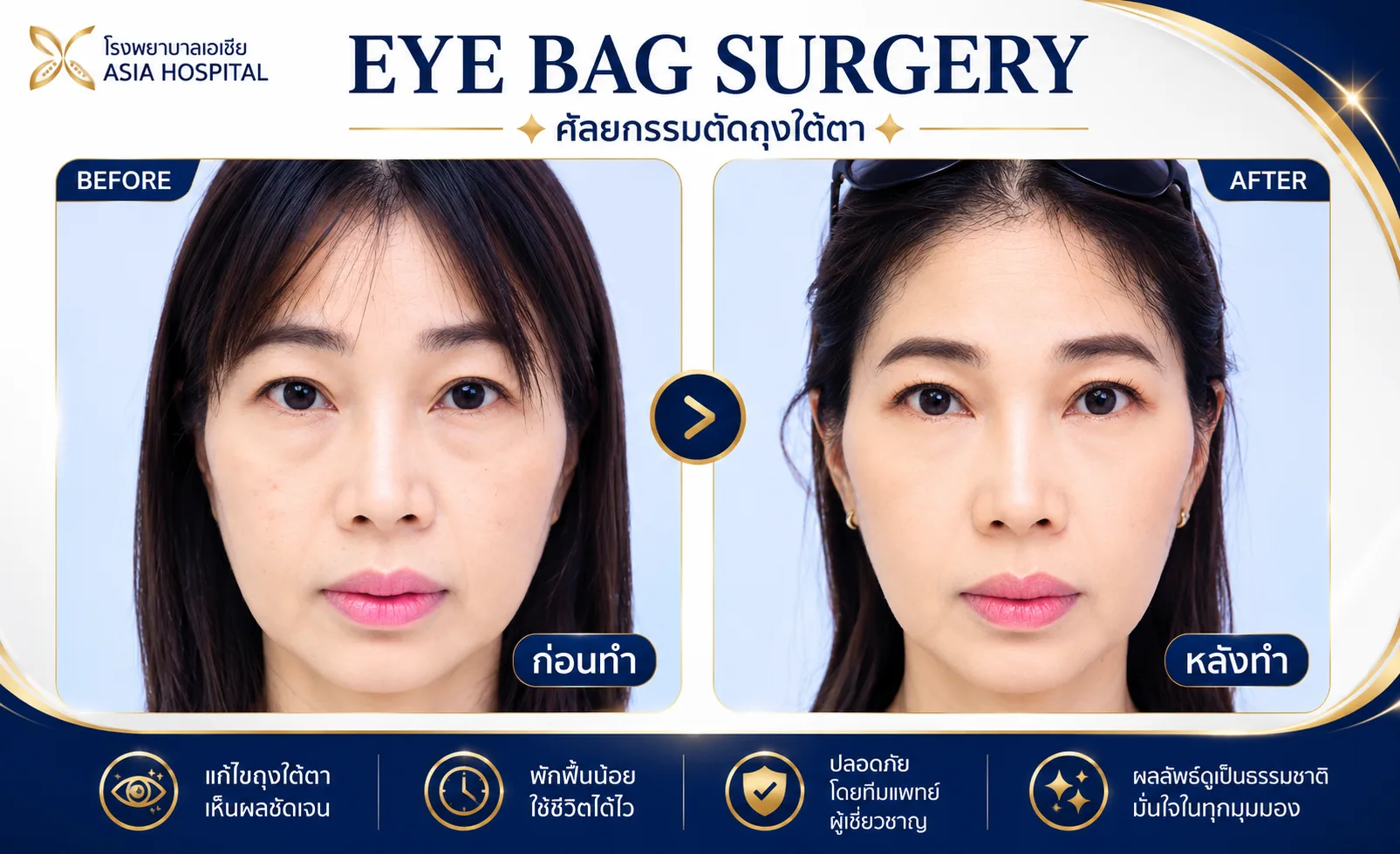 ก่อน-หลัง ศัลยกรรมตา