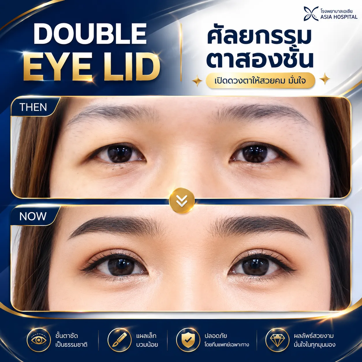 ก่อน-หลัง ตาสองชั้น