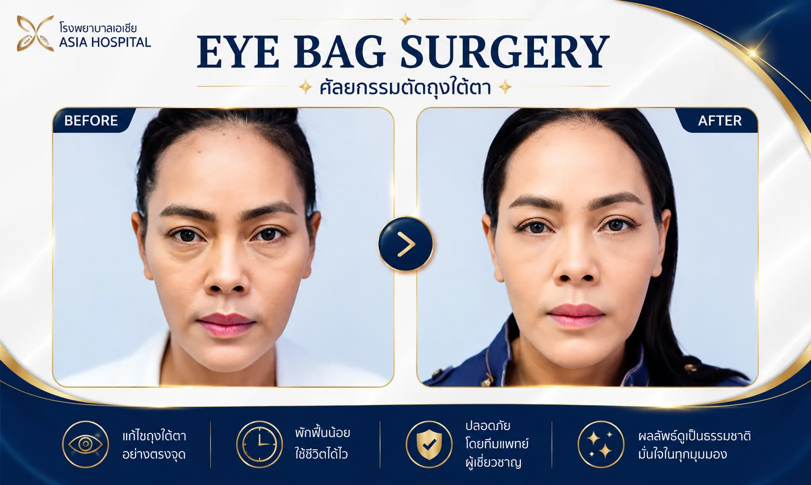 ก่อน-หลัง ถุงใต้ตา