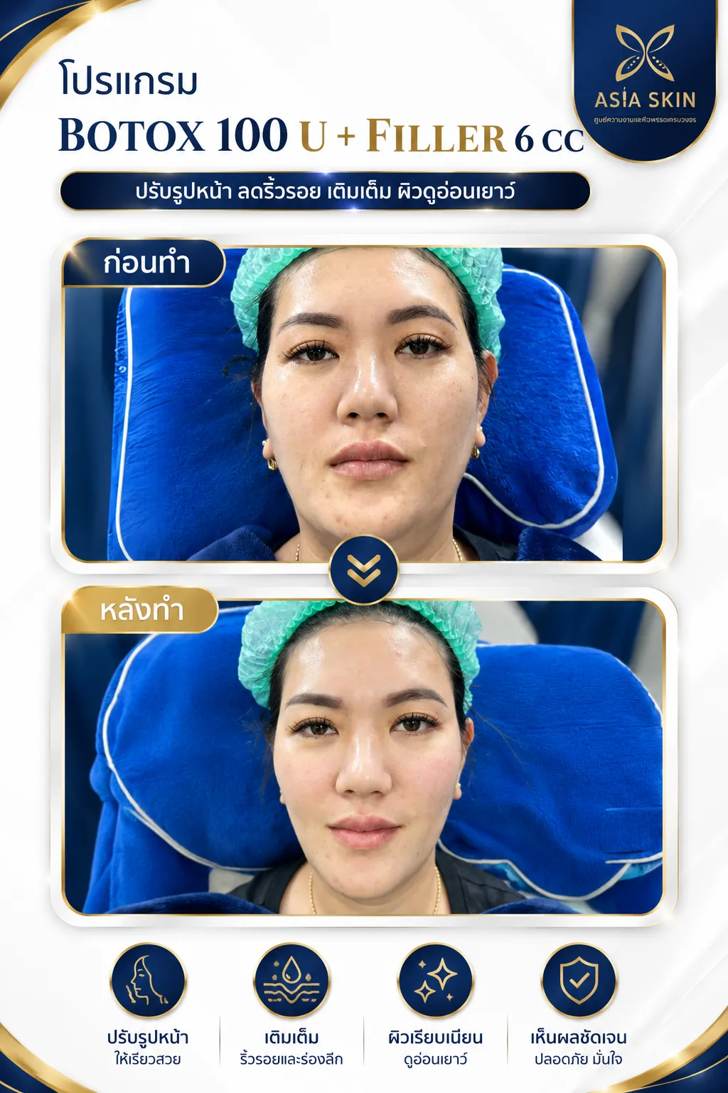 ก่อน-หลัง ปรับรูปหน้า