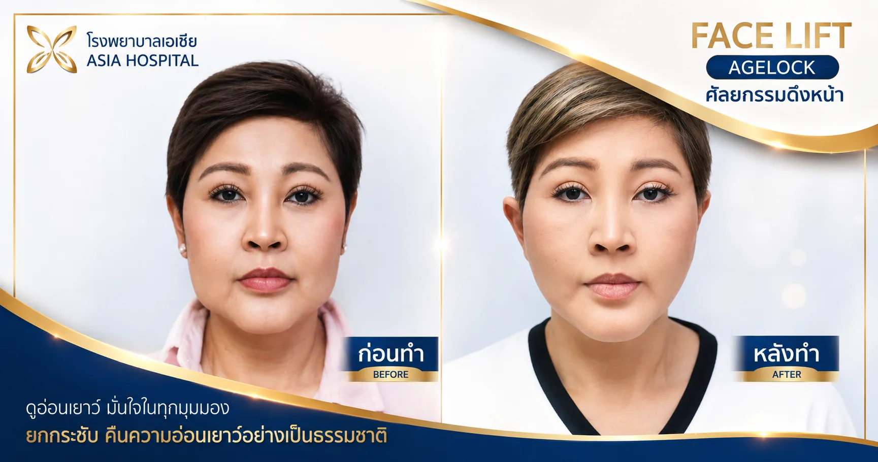 ก่อน-หลัง ศัลยกรรมดึงหน้า