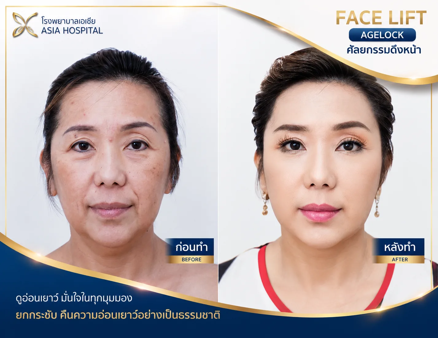 ก่อน-หลัง ศัลยกรรมดึงหน้า