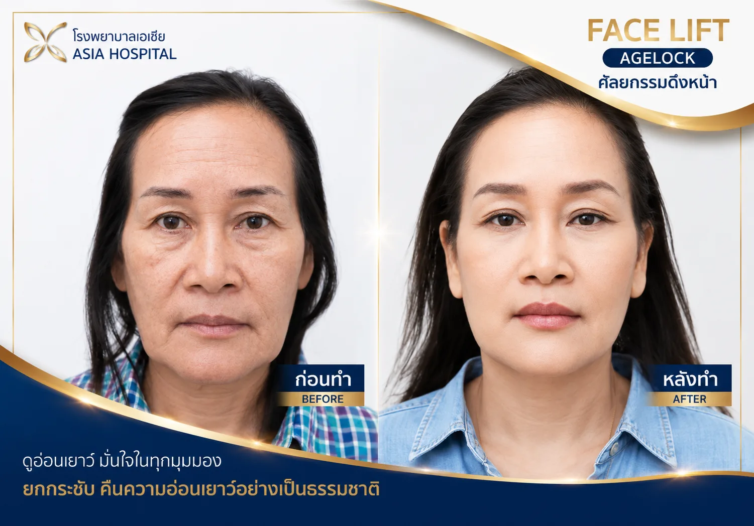 ก่อน-หลัง ศัลยกรรมดึงหน้า