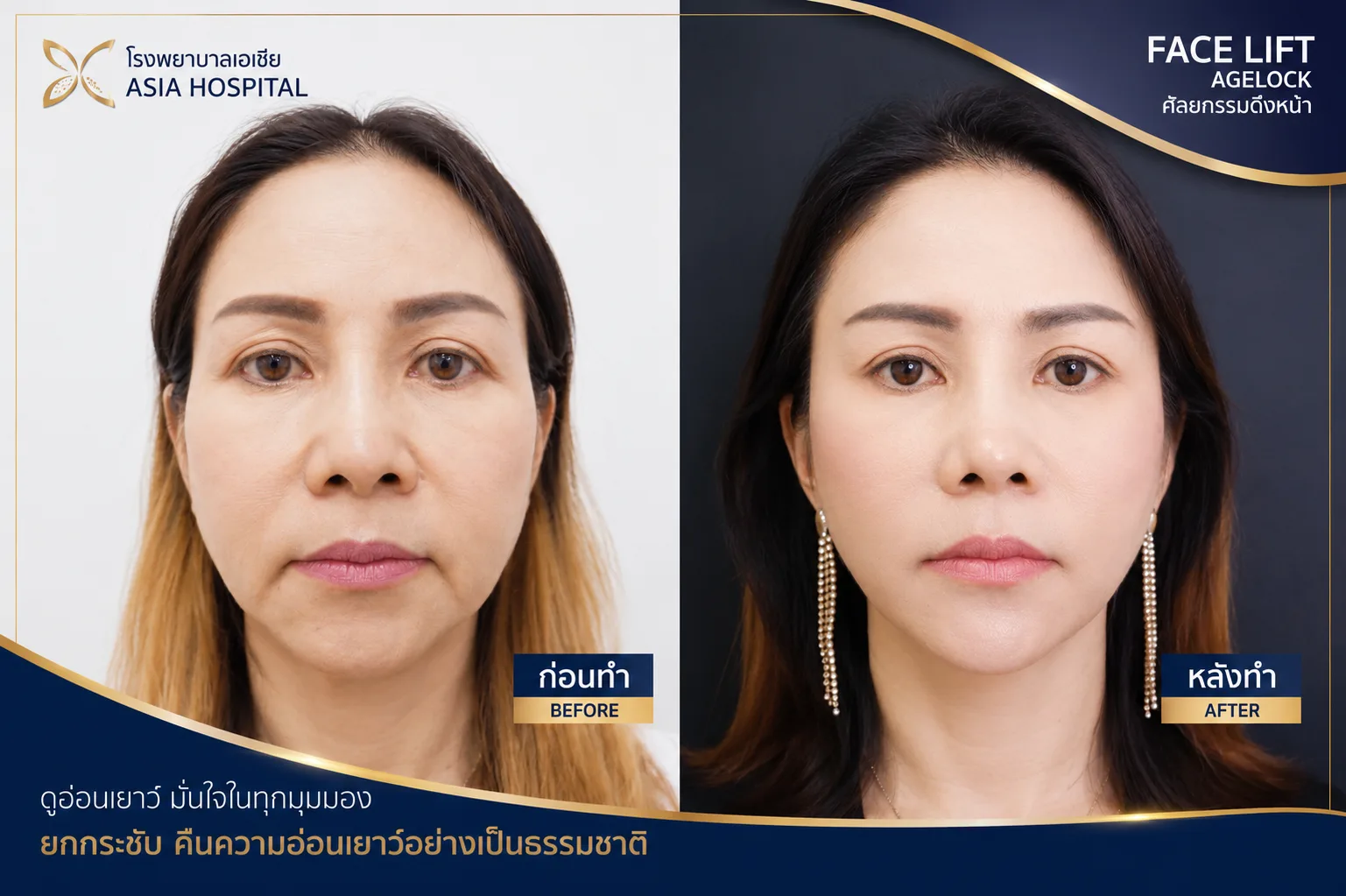 ก่อน-หลัง ศัลยกรรมดึงหน้า