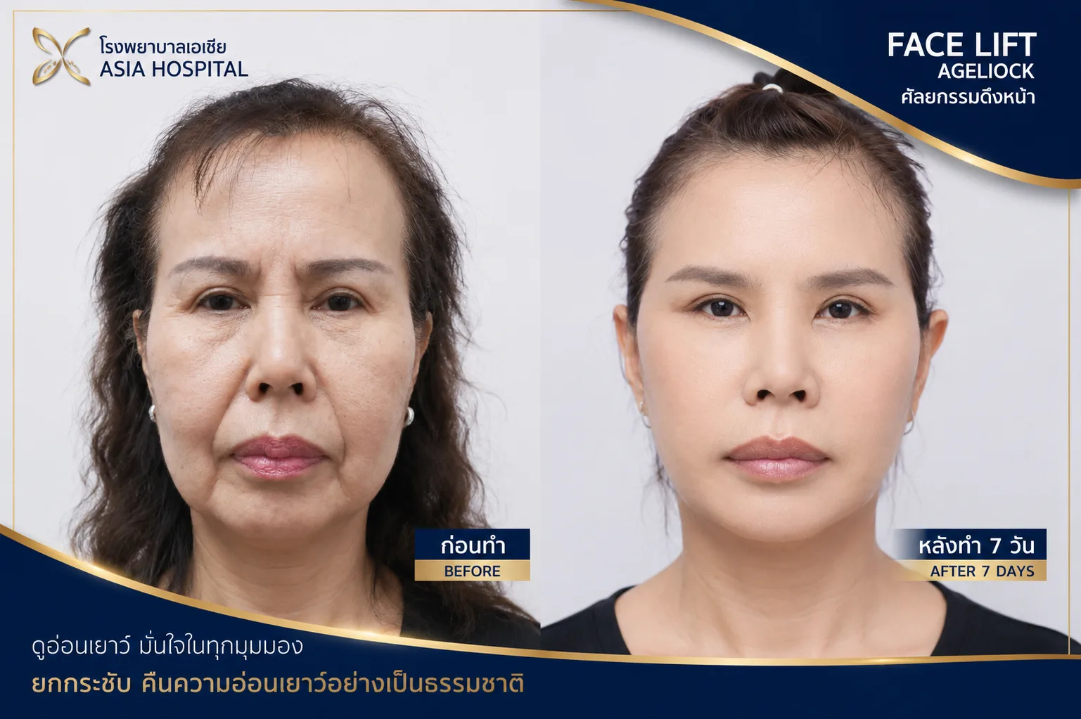 ก่อน-หลัง ศัลยกรรมดึงหน้า