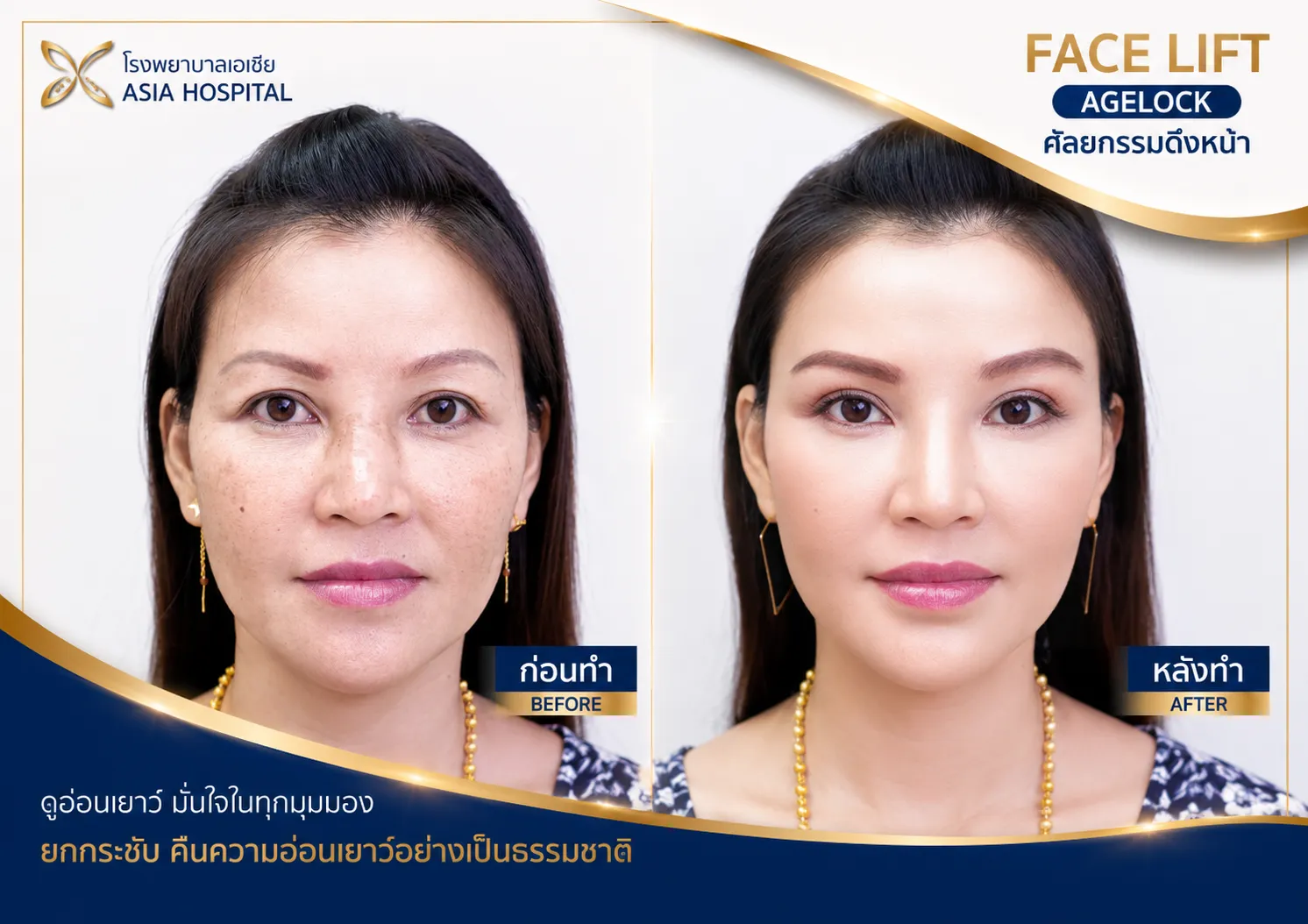 ก่อน-หลัง ดึงหน้า