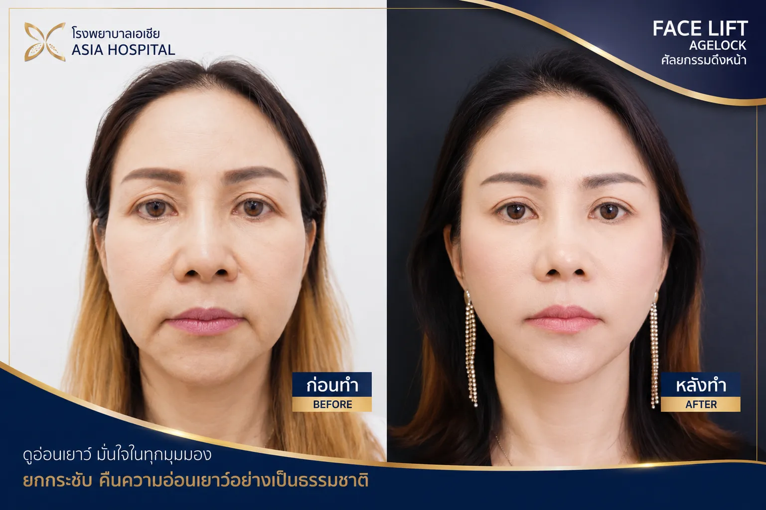 ก่อน-หลัง ยกกระชับ