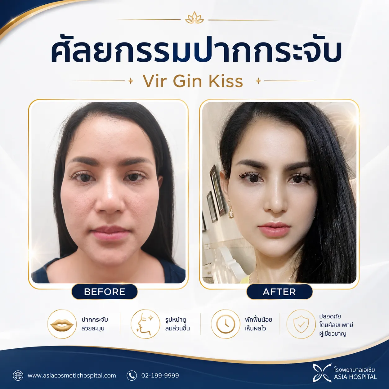 ศัลยกรรมปาก ก่อน-หลัง