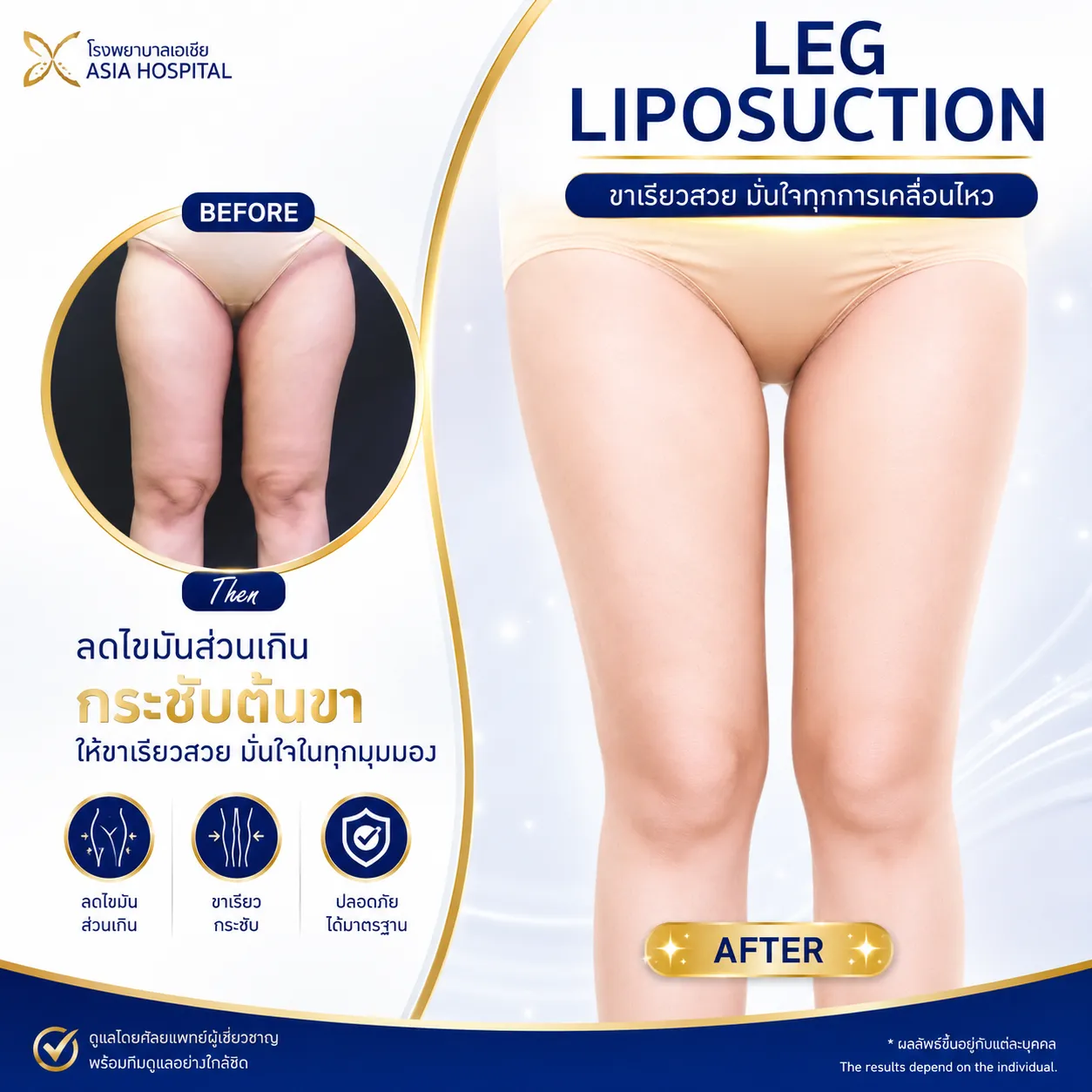 ก่อน-หลัง กระชับต้นขา