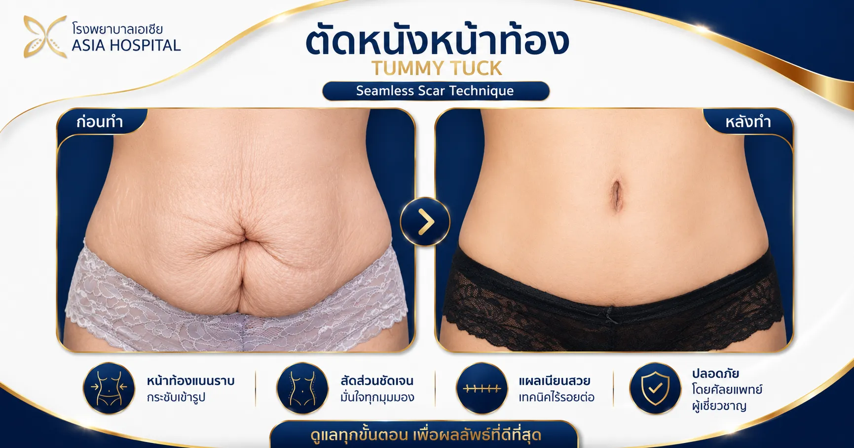 ก่อน-หลัง ตัดหนังหน้าท้อง