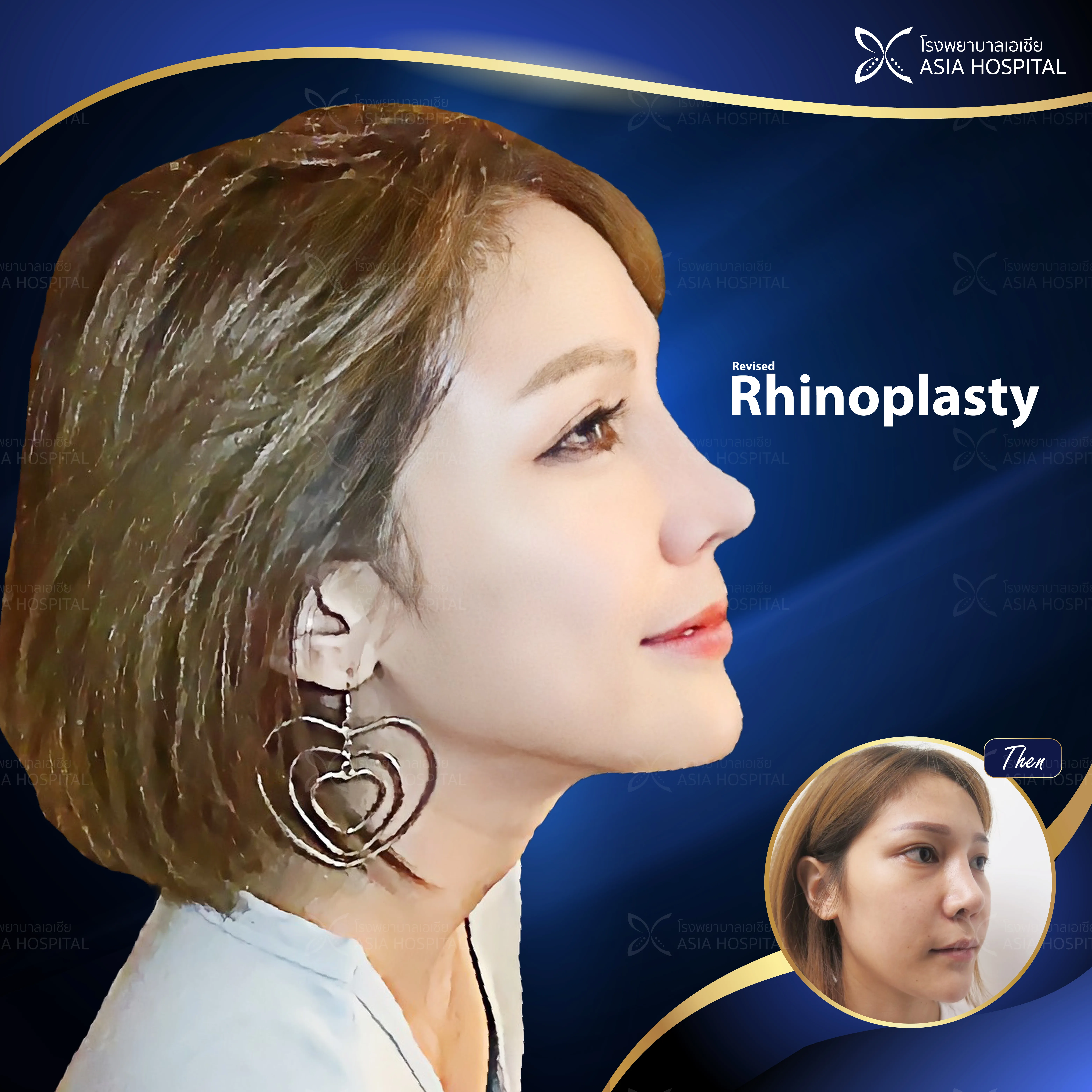 ก่อน-หลัง ศัลยกรรมจมูก