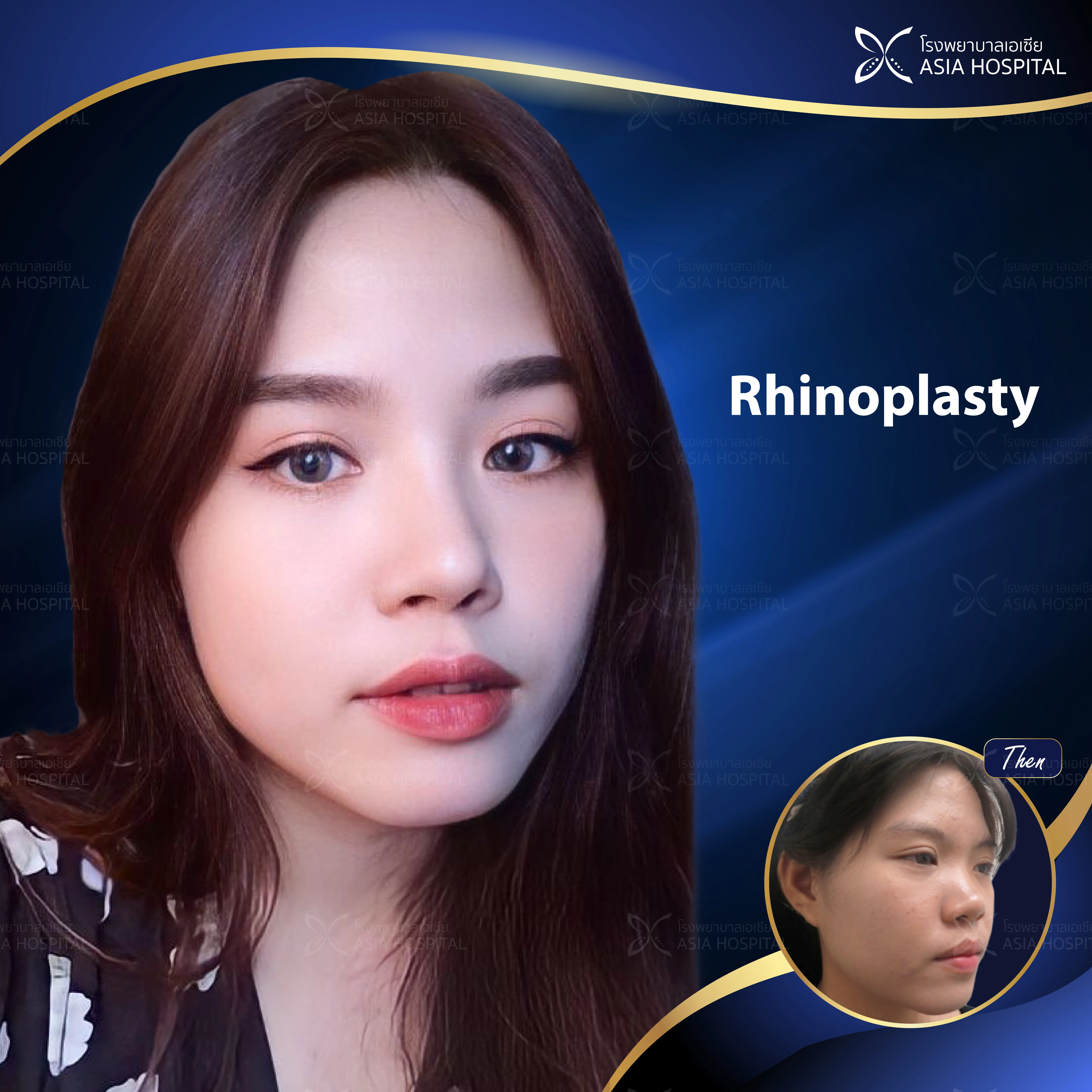 ก่อน-หลัง ศัลยกรรมจมูก