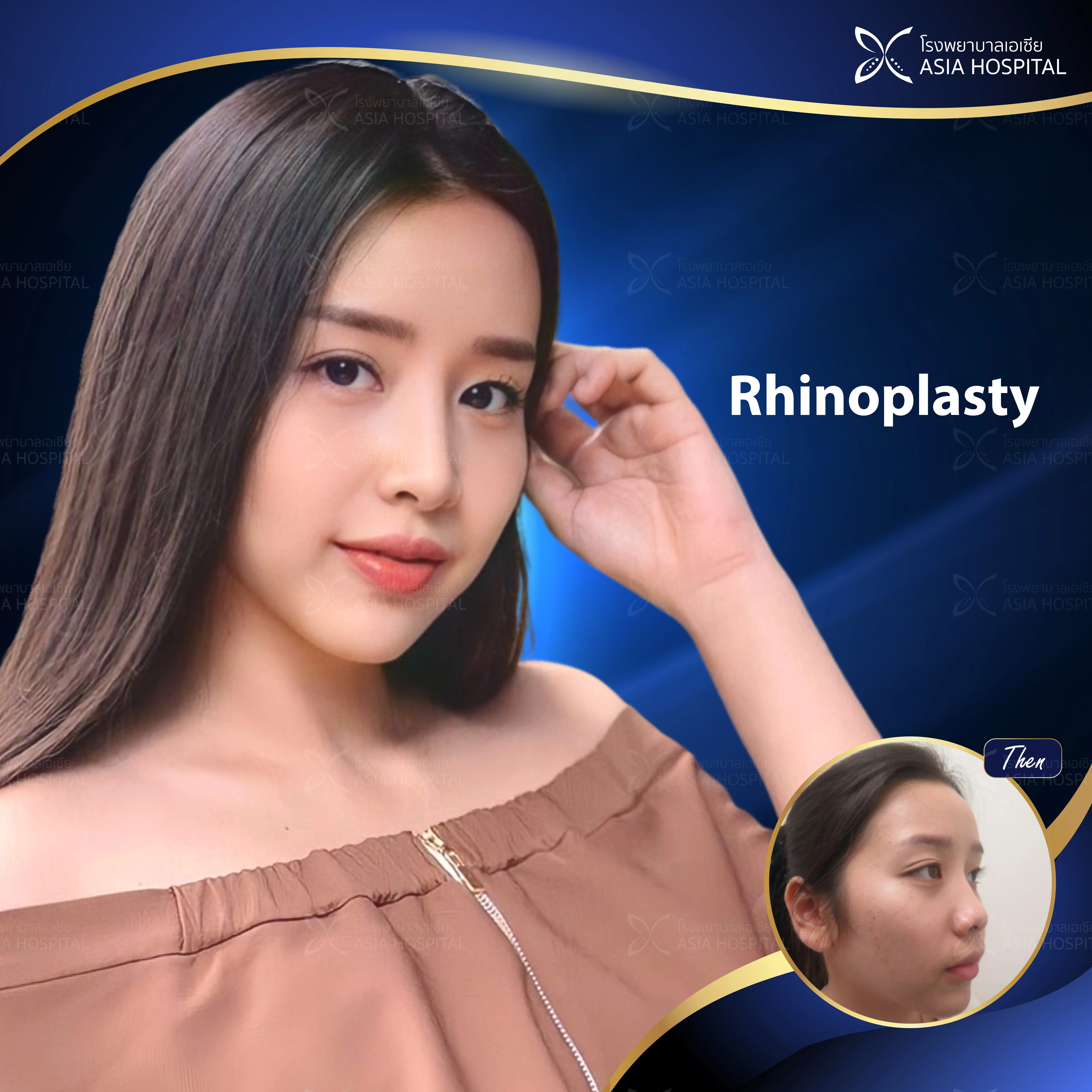 ก่อน-หลัง ศัลยกรรมจมูก