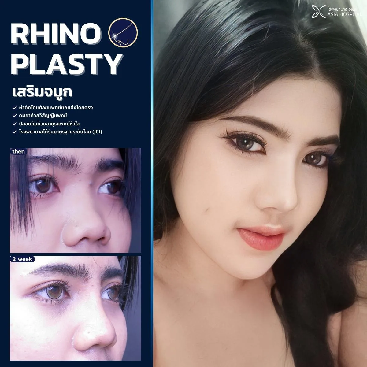 ก่อน-หลัง ศัลยกรรมจมูก