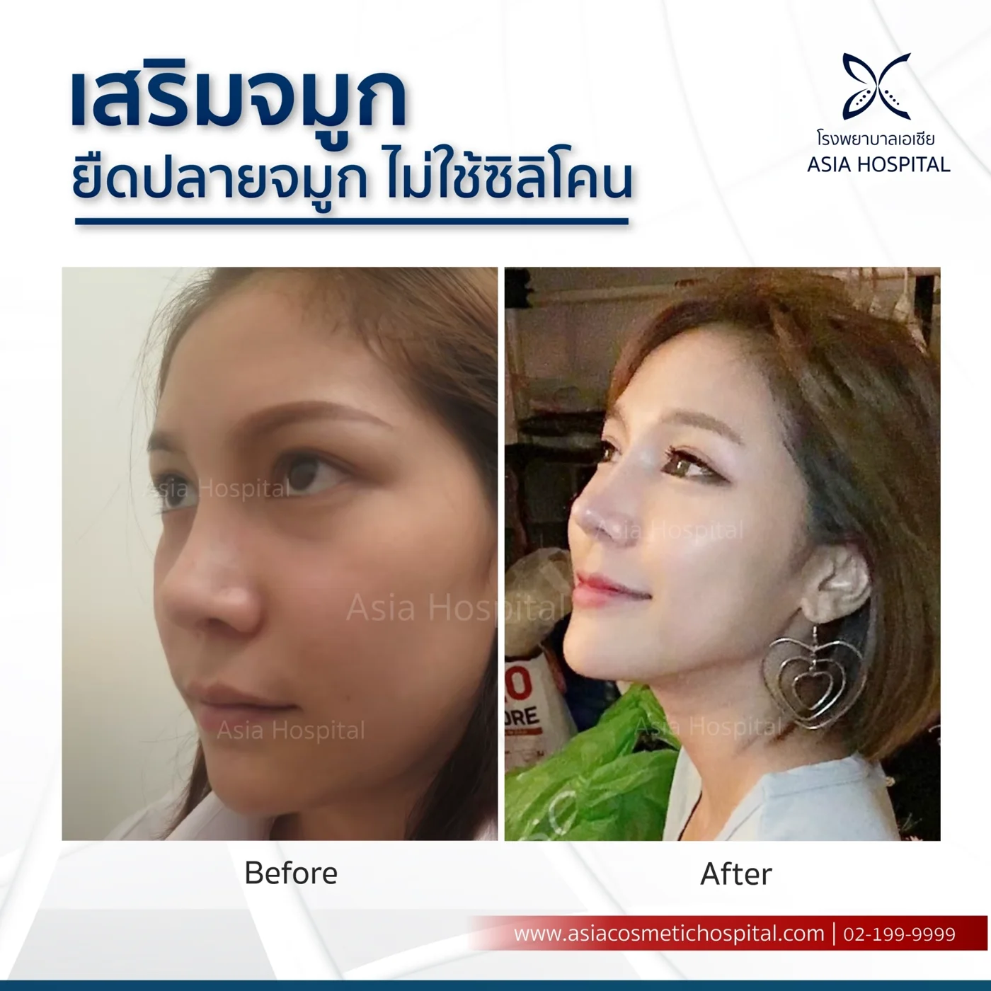 ก่อน-หลัง ศัลยกรรมจมูก