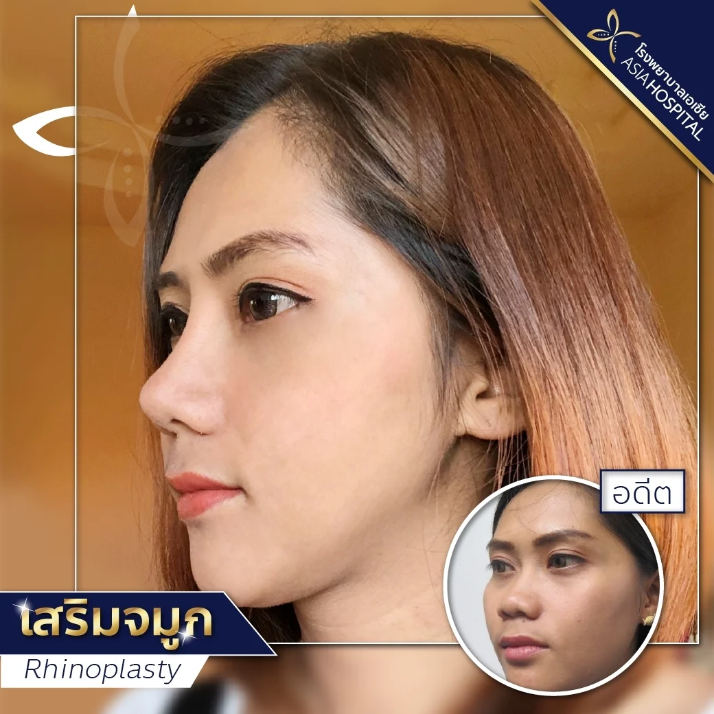 ก่อน-หลัง ศัลยกรรมจมูก
