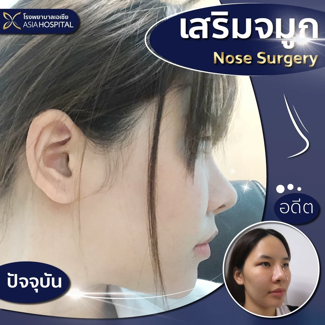 ก่อน-หลัง ศัลยกรรมจมูก