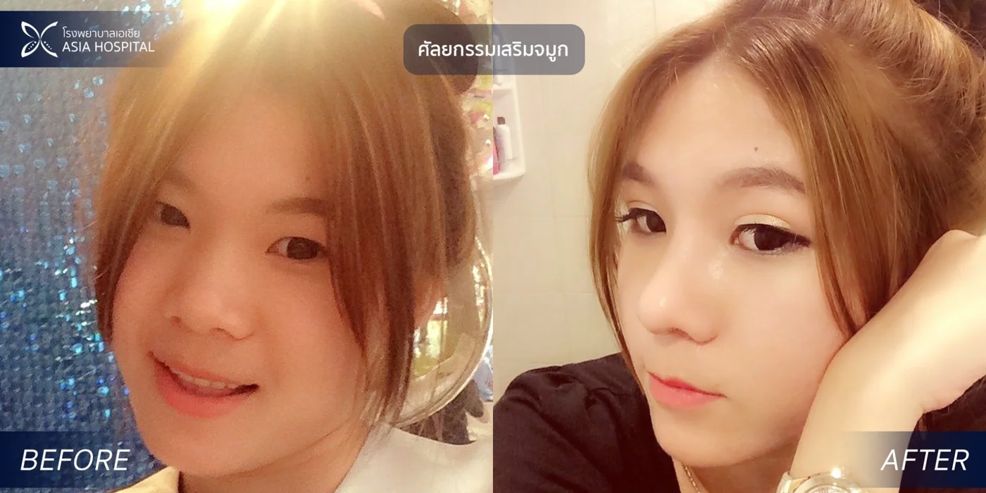 ก่อน-หลัง ศัลยกรรมจมูก