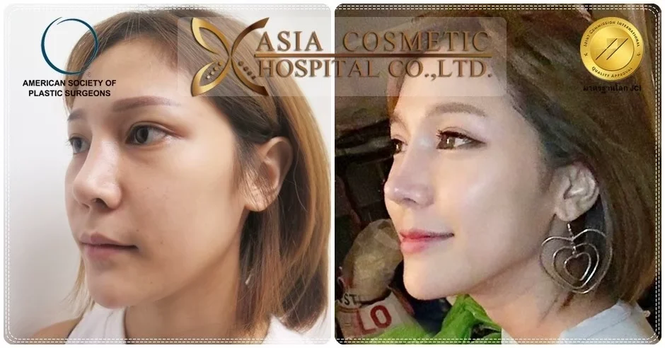 ก่อน-หลัง ศัลยกรรมจมูก