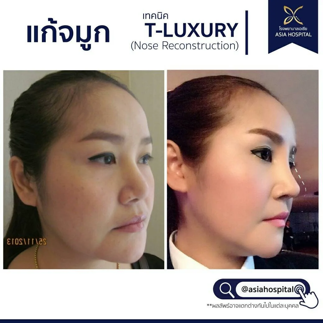 ก่อน-หลัง ศัลยกรรมจมูก