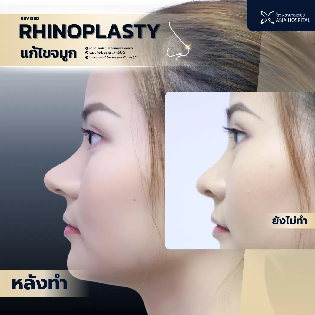 ก่อน-หลัง เสริมจมูก