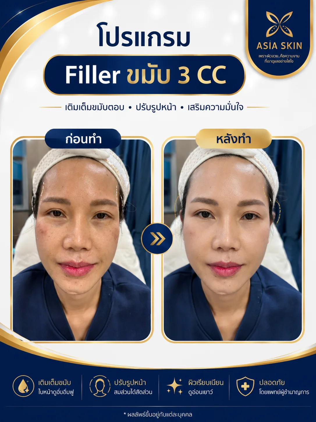 ก่อน-หลัง Fillerขมับ