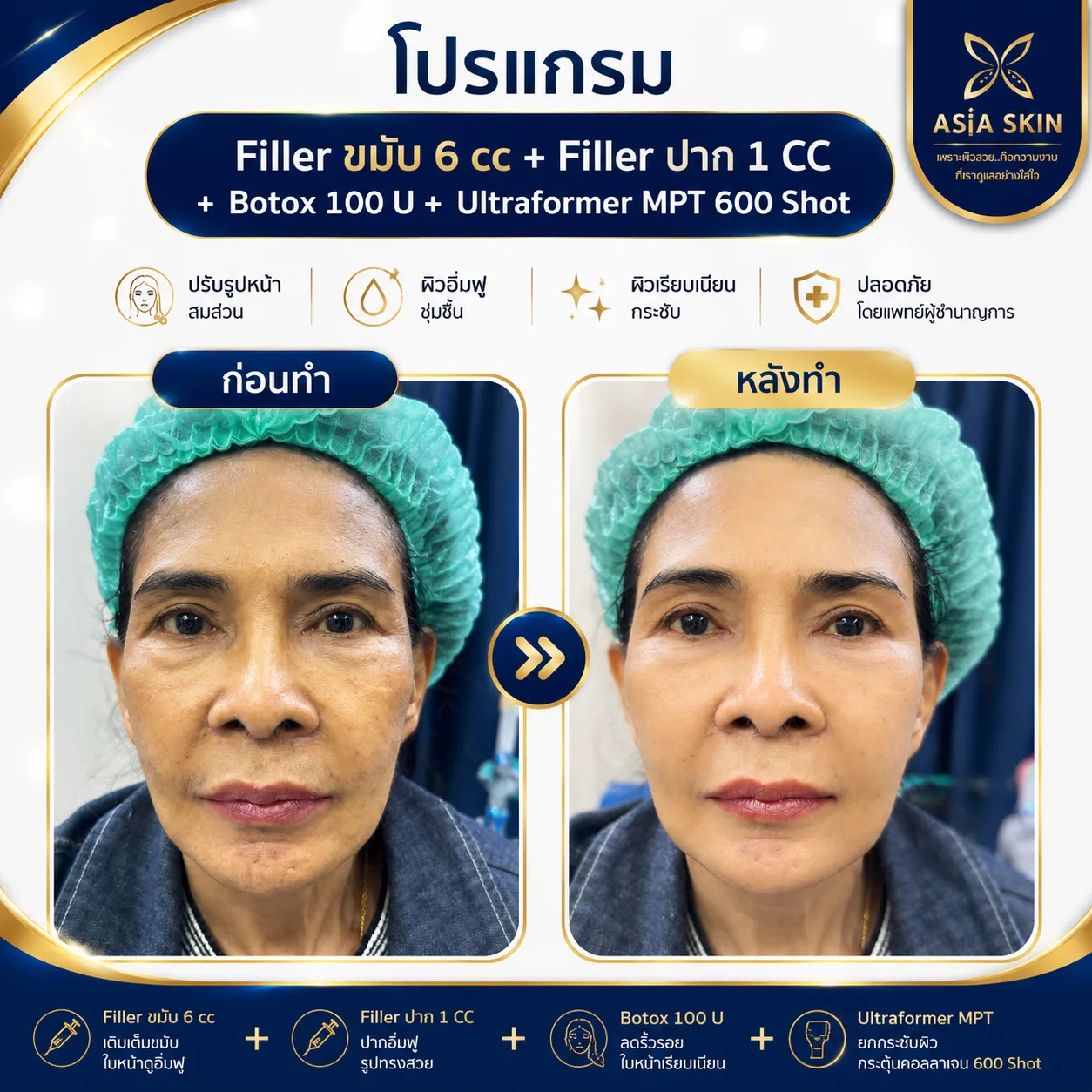 ก่อน-หลัง FillerขมับFillerปาก