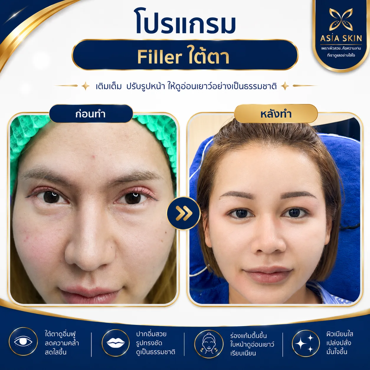 ก่อน-หลัง Fillerใต้ตา