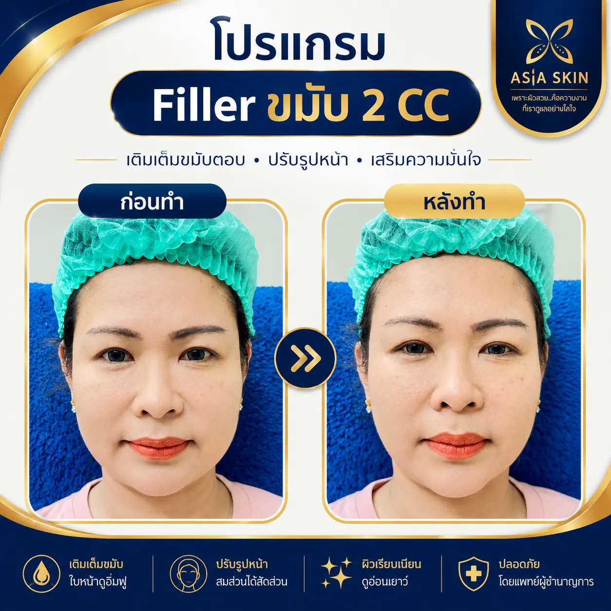 ก่อน-หลัง ฟิลเลอขมับ