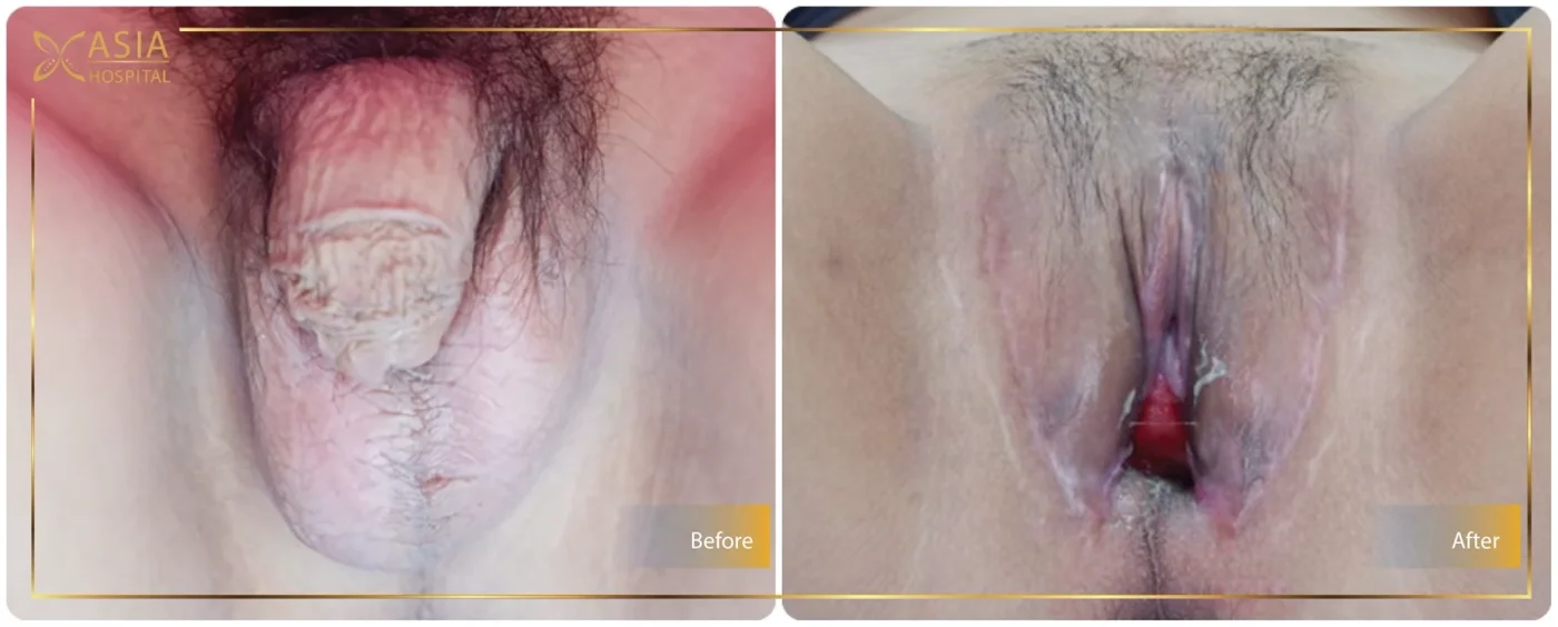 ก่อน-หลัง ศัลยกรรมแปลงเพศ