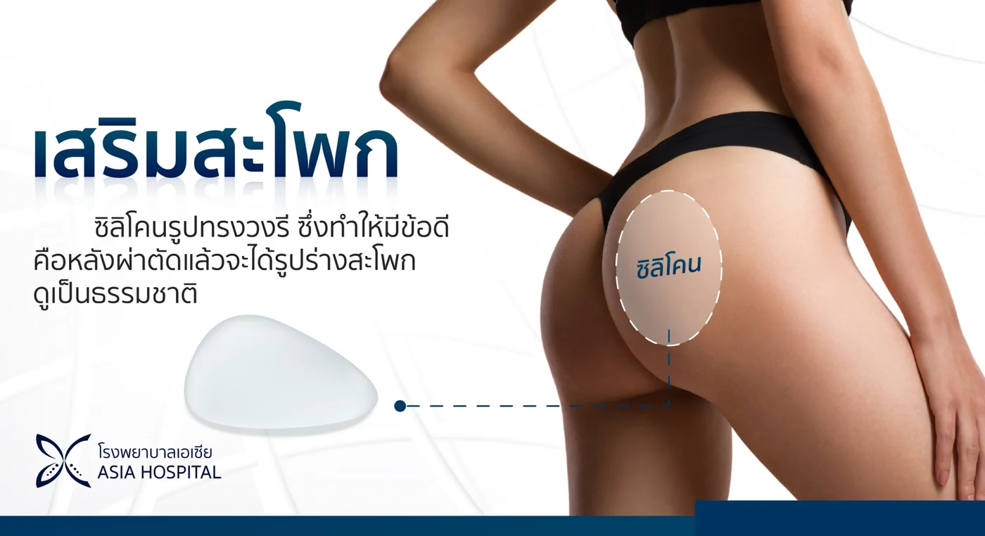 ข้อมูลการเสริมสะโพกด้วยซิลิโคนรูปทรงวงรี ซึ่งให้รูปร่างสะโพกที่ดูเป็นธรรมชาติหลังผ่าตัด พร้อมภาพแสดงตำแหน่งที่วางซิลิโคน