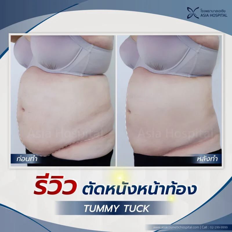 ภาพเปรียบเทียบก่อนและหลังการตัดหนังหน้าท้อง แสดงหน้าท้องที่กระชับและเรียบขึ้น