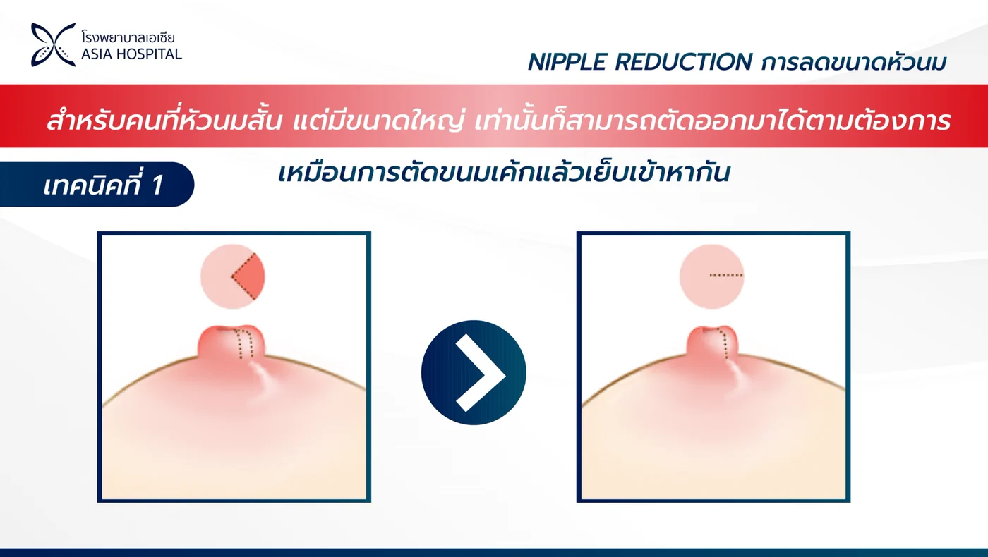 แผนภาพเทคนิคที่ 1 ของการลดขนาดหัวนม สำหรับผู้ที่หัวนมสั้นแต่มีขนาดใหญ่ ตัดเนื้อส่วนเกินออกแล้วเย็บเข้าหากัน