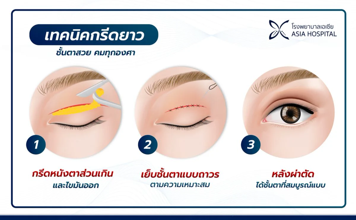 แผนภาพเทคนิคกรีดยาว 3 ขั้นตอน กรีดหนังตาส่วนเกินและไขมันออก เย็บชั้นตาแบบถาวร และชั้นตาหลังผ่าตัด
