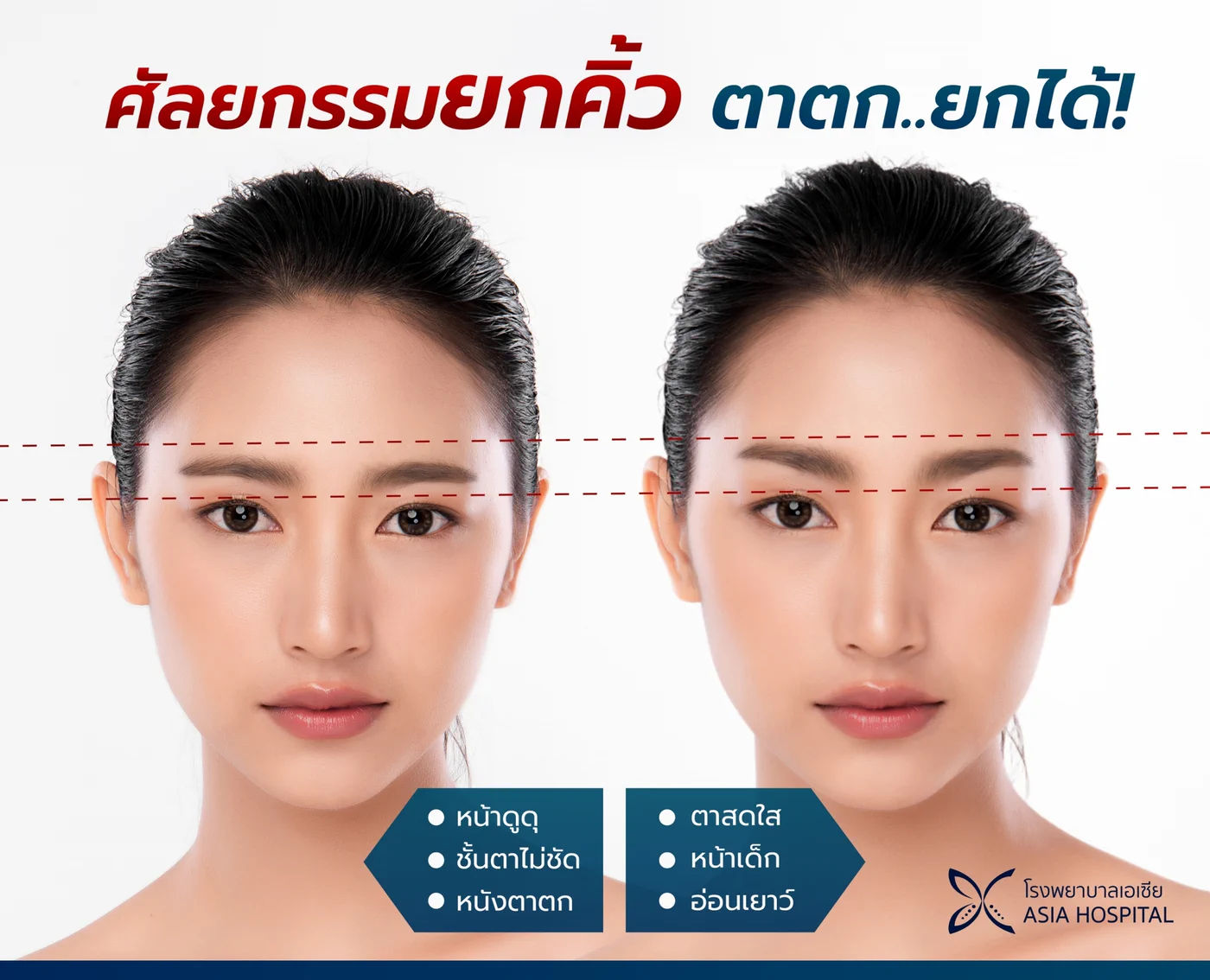 ภาพเปรียบเทียบก่อนและหลังศัลยกรรมยกคิ้ว จากหน้าดูดุ ชั้นตาไม่ชัด หนังตาตก เป็นตาสดใส หน้าดูอ่อนเยาว์