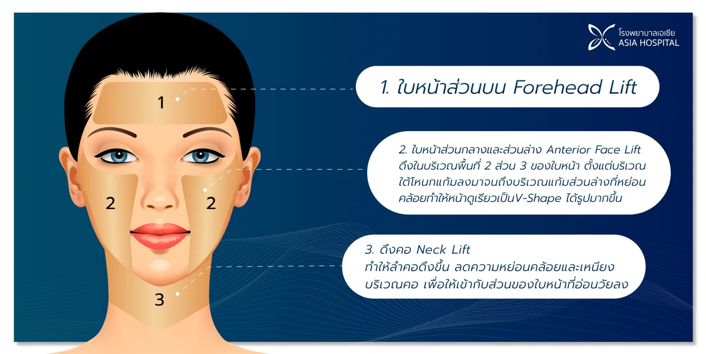 แผนภาพแบ่งใบหน้าเป็น 3 บริเวณสำหรับการดึงหน้า ใบหน้าส่วนบน Forehead Lift ใบหน้าส่วนกลางและส่วนล่าง Anterior Face Lift และลำคอ Neck Lift