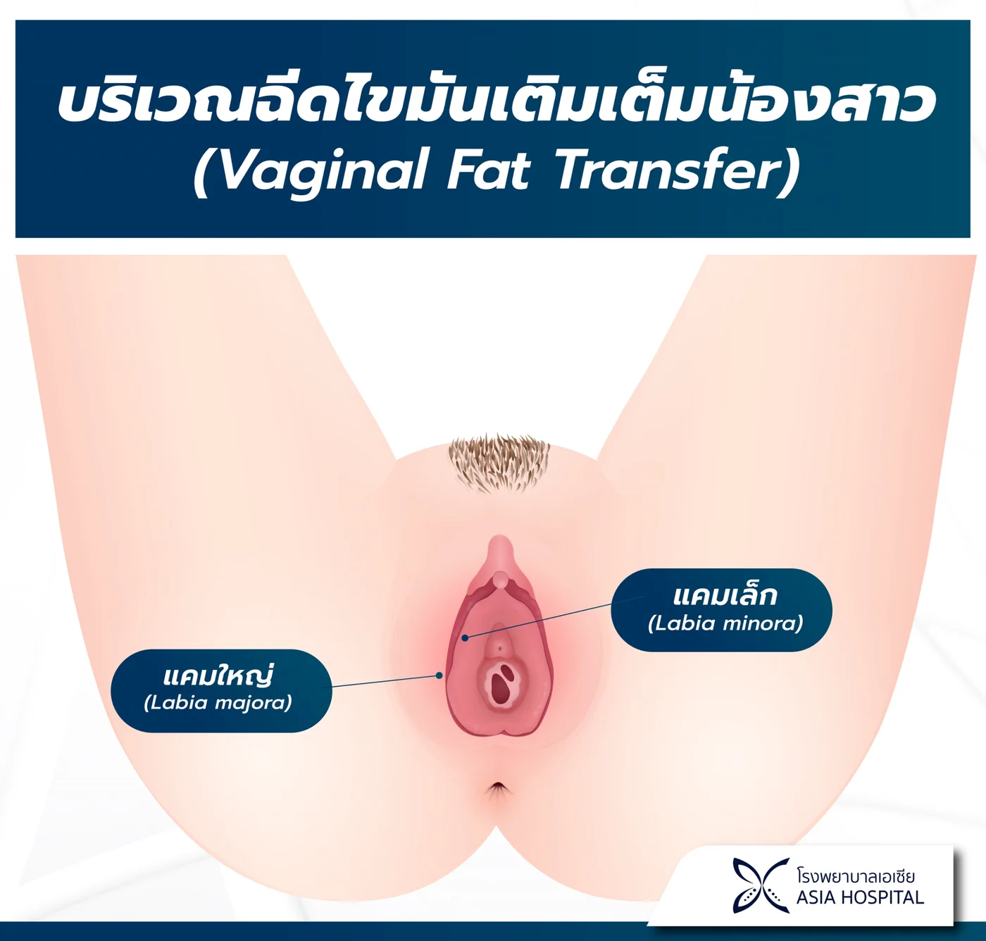 แผนภาพกายวิภาคแสดงบริเวณที่ฉีดไขมันเติมเต็มน้องสาว (Vaginal Fat Transfer) พร้อมระบุตำแหน่งแคมเล็ก (Labia minora) และแคมใหญ่ (Labia majora)