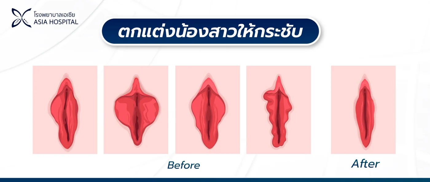 ภาพเปรียบเทียบลักษณะแคมก่อนและหลังการผ่าตัดตกแต่งให้กระชับได้รูป