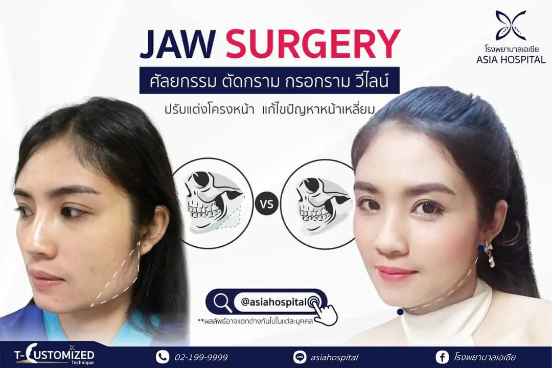 ขั้นตอนการผ่าตัด T-Square Jaw Surgery