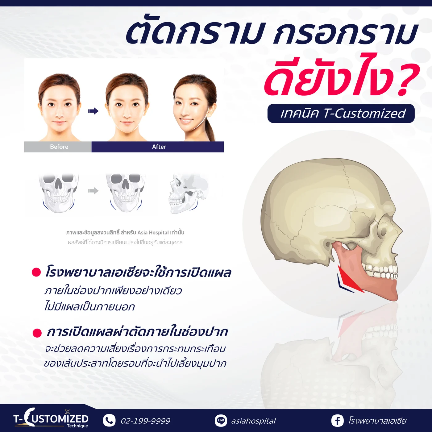ภาพเปรียบเทียบก่อนและหลังตัดกราม กรอกราม ด้วยเทคนิค T-Customized พร้อมแผนภาพกระดูกกรามที่ถูกตัด และคำอธิบายว่าโรงพยาบาลเอเซียเปิดแผลภายในช่องปากเท่านั้น