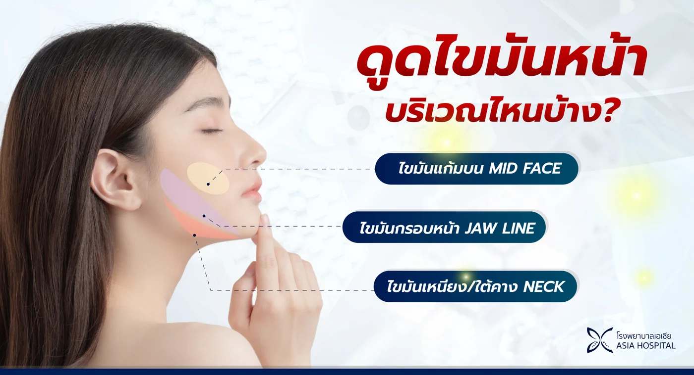 แผนภาพบริเวณที่ดูดไขมันบนใบหน้าได้ ไขมันแก้มบน (Mid Face) ไขมันกรอบหน้า (Jaw Line) และไขมันเหนียงใต้คาง (Neck)